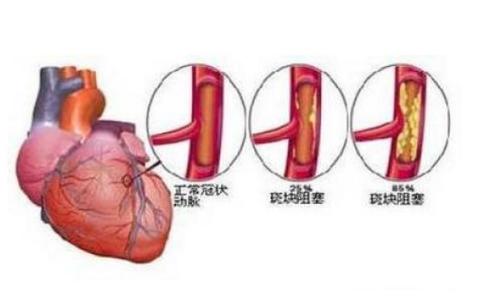 冠心病有哪些症状表现 冠心病有哪些症状表现 冠心病都有哪些症状