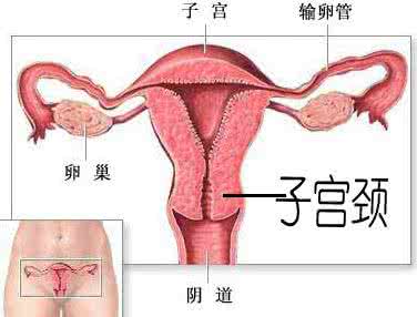 可视无痛人流术是什么 可视无痛人流术 什么是宫颈息肉