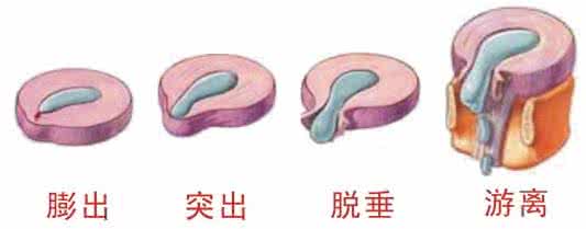 腰椎间盘突出症的原因 腰椎间盘突出的原因！ 该如何治疗？？