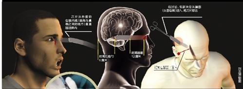 男子脑瘤太硬换刀片 刀片飞入脑中男子浑然不觉 4小时手术将其取出