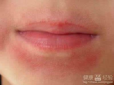 皮肤过敏可以吃猪蹄吗 皮肤过敏能吃鸡腿菇吗