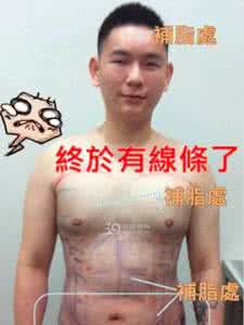 胖子抽脂变型男 胖子抽脂变型男 一个210多斤的胖子，是怎么变成155斤型男的？