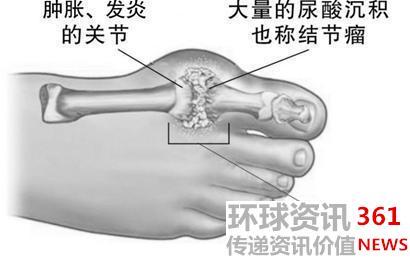 痛风到底有多痛 痛风，到底有多“痛”