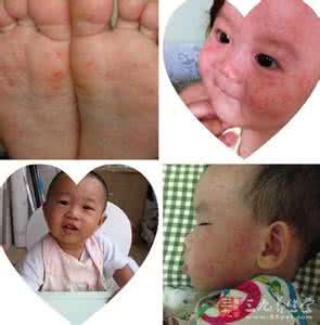 幼儿急疹怎么治疗 幼儿急疹怎么治疗 幼儿急疹的治疗方法是什么