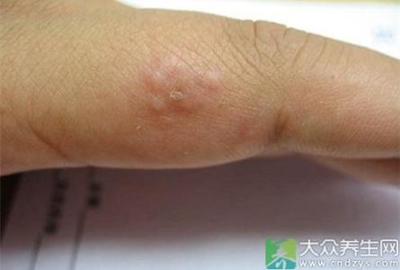 糖尿病皮肤瘙痒症状 皮肤上长这东西必定是糖尿病