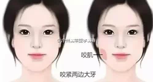打瘦脸针多久有效果 瘦脸针多久之后有效果 瘦脸针打了三次之后，她的脸真的没再大过！