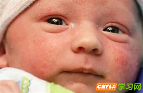 婴儿湿疹反复发作原因 婴儿湿疹反复发作 婴儿湿疹反复发作最好的治疗方法