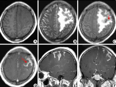 脑出血后遗症偏瘫秘方 脑膜炎,脑出血秘方