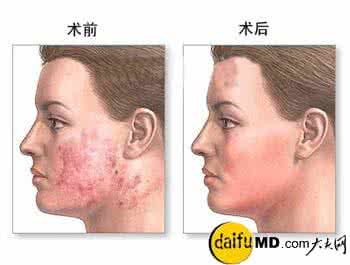 疤痕修复术费用 疤痕修复术 修复疤痕