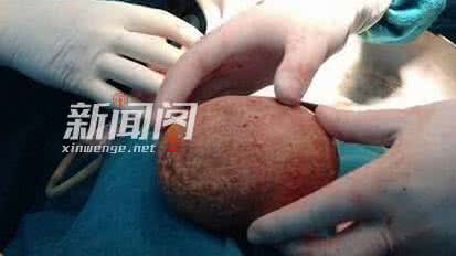 膀胱内取出鸭蛋大结石 膀胱取出2斤结石 患结石如何看出来