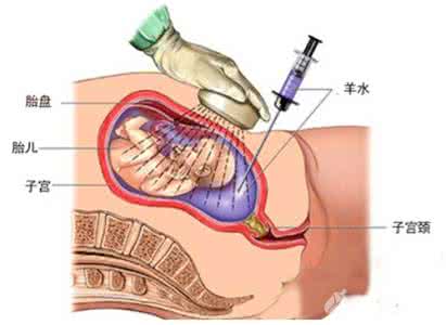 羊水穿刺怎么做疼不疼 羊水穿刺怎么做