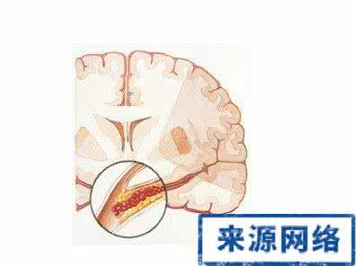 脑血栓前兆 疾病预防 脑血栓