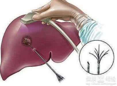 肝囊肿有什么症状 肝囊肿严重吗 肝囊肿有哪些症状