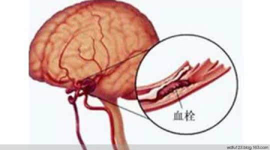 脑血栓的治疗方法 治疗脑血栓秘方