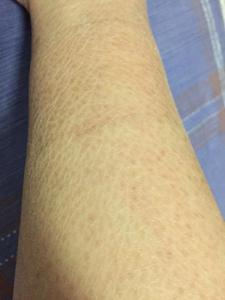 鱼鳞病最佳治疗方法 鱼鳞病怎么治 轻微鱼鳞病的治疗方法有这些