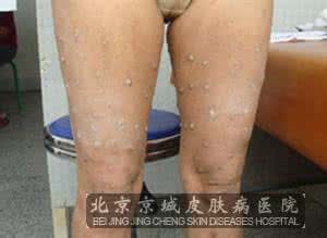 结节性痒疹怎么能除根 结节性痒疹 正确预防结节性痒疹很重要