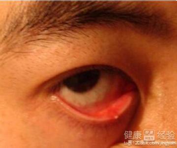 什么是麦粒肿初期症状 麦粒肿的症状