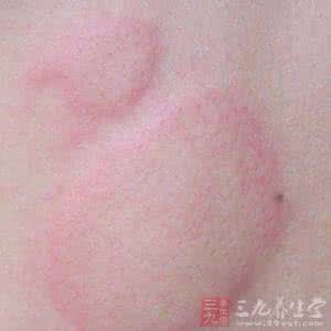 荨麻疹症状会传染吗 荨麻疹会传染吗 这些都是荨麻疹的症状