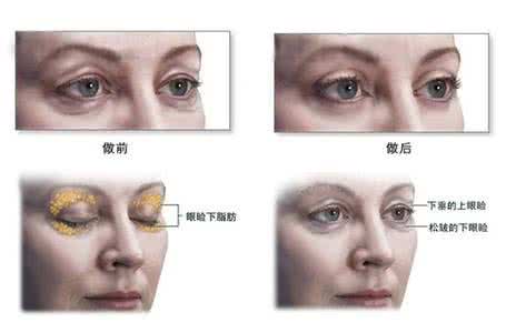 去眼袋手术危险吗 眼袋手术 对于眼袋手术的一些误区