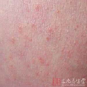 湿疹怎么治疗 教你四招和“痒”说拜拜