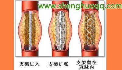 心脏血管堵塞不放支架 血管堵塞必须放支架吗 毁掉你的血管有N种方法，四成国人必选两种
