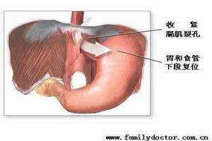 食管裂孔疝的症状 食管裂孔疝的症状 这些症状你都知道吗