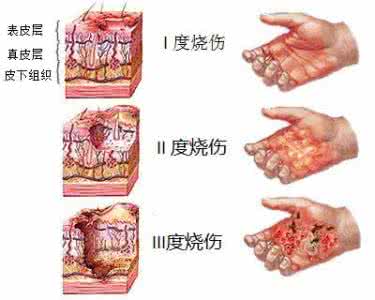 如何治疗轻度烧伤视频 如何区分轻度烧伤和大面积烧伤呢