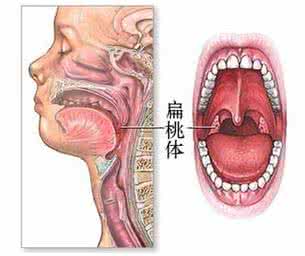 急性扁桃体炎吃什么药 扁桃体炎打什么针？