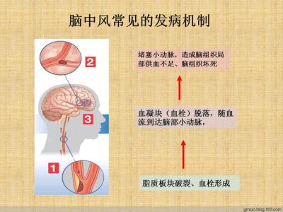 头颈肩关系 活动头颈肩 预防脑中风