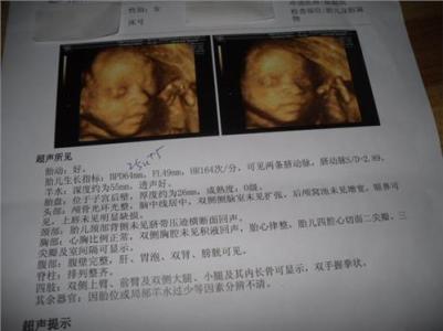 三维和四维多少钱一次 三维彩超多少钱