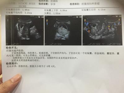 b超看男女准确率多少 b超看男女准确率多少 孕早期看宝宝男女，这个方法准确率99.5%！要试试