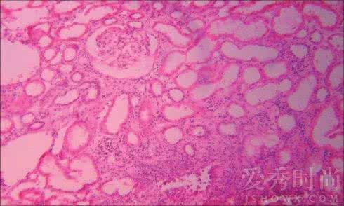慢性间质性肾炎 慢性间质性肾炎 慢性间质性肾炎的并发症