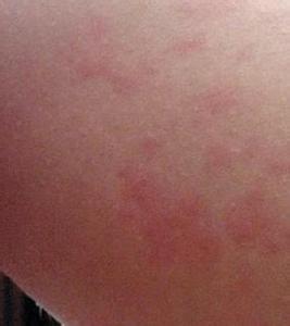 赵炳南 荨麻疹 (2)慢性荨麻疹 赵炳南