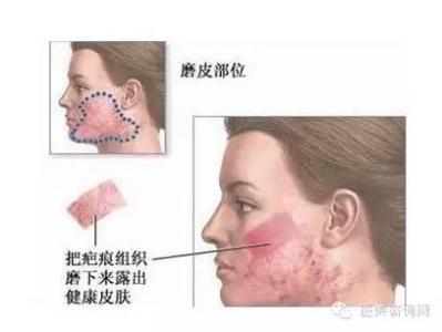 疤痕能不能去除 疤痕能不能去除 什么工作不能有疤痕?