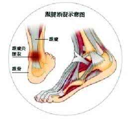 跟腱炎的治疗偏方 跟腱炎的治疗偏方 跟腱炎的偏方