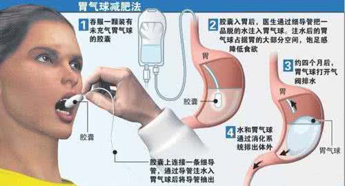 胃食道双气囊压迫 新型胃气囊技术减肥效果理想