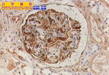 肾炎治疗费用多少 中西结合治疗系膜增生性肾炎