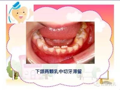 牙齿食物残渣恶臭 吃这些“臭”食物对牙齿好