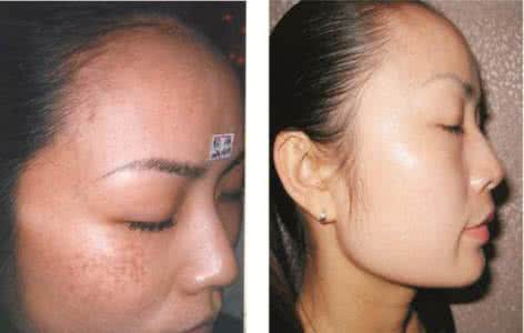 激光去痘印大概价格 激光可以去痘印吗 价格是多少