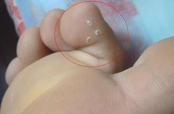 治疗尖锐最好的中药方 治疗尖锐最好的中药方 脚气用什么药最好 治疗脚气的中药方