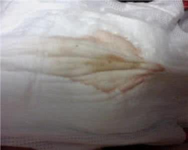 腰困疼是怎么回事 一边的腰困怎么回事?