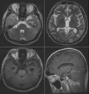 脑出血核磁共振影像 脑出血核磁共振影像 脑核磁有密度影是什么？