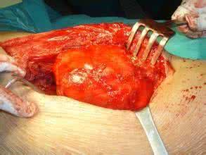 中医治疗肉瘤 中医治疗脂肪肉瘤