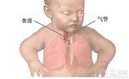 解读男科常见疾病 新生儿肺炎是常见的危险疾病全解