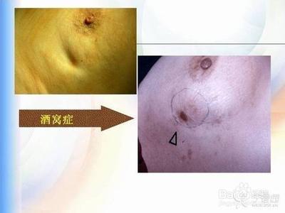 早期乳腺癌的症状图片 乳腺癌的早期症状 乳腺癌症状图片