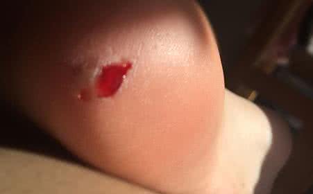 破伤风症状 破伤风症状 这几点不可忽视！