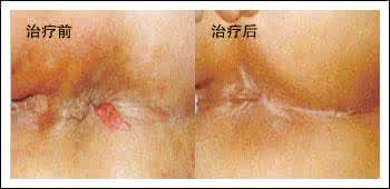 治疗肛裂的药膏哪款好 肛裂治疗