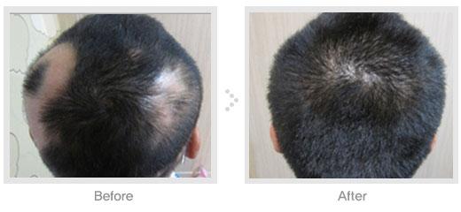 男性掉头发的治疗方法 掉头发怎么办呢