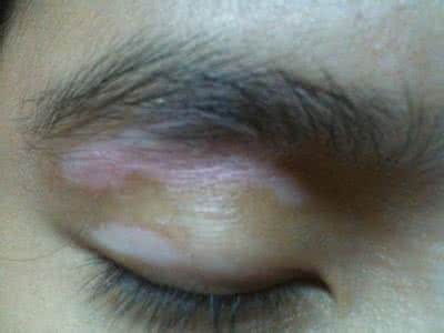 皮肤有一片颜色变浅 脸上有一块皮肤颜色浅 皮肤颜色浅容易得白癜风？