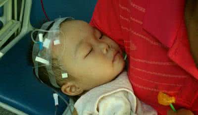 地中海贫血有什么症状 地中海贫血是什么